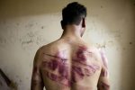 A Syrian man shows marks of torture on his back, after he was released from regime forces, in the Bustan Pasha neighbourhood of Syria's northern city of Aleppo on August 23, 2012. State media hailed the recapture by the army of three Christian neighbourhoods in the heart of Aleppo, but clashes between troops and rebel fighters raged in other parts of the city and in the southern belt of Damascus. AFP PHOTO / JAMES LAWLER DUGGAN / AFP PHOTO / JAMES LAWLER DUGGAN